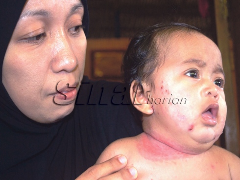 Pipi, leher bayi bernanah akibat ubat klinik yang bahaya 