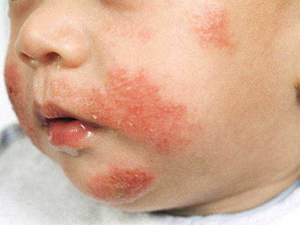 Image result for kesan eczema teruk